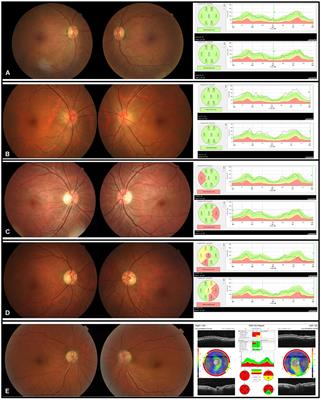 Mitochondrial Mutations in Ethambutol-Induced Optic Neuropathy